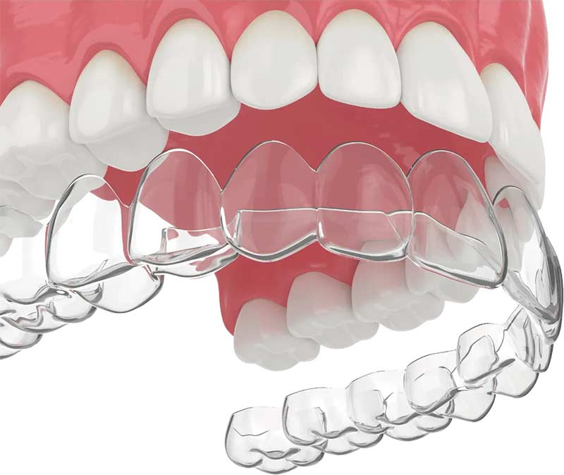 Clear Aligners in Pflugerville and Round Rock