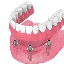 Snap-On Dentures Round Rock